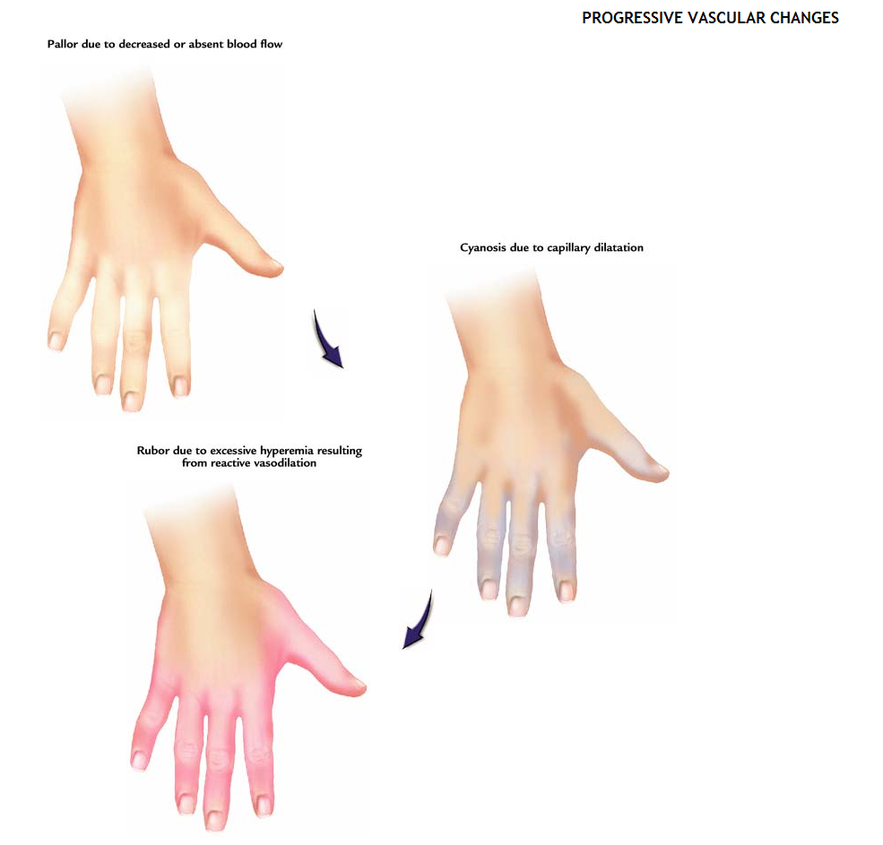 Raynaud's Disease - NEWNMCLE