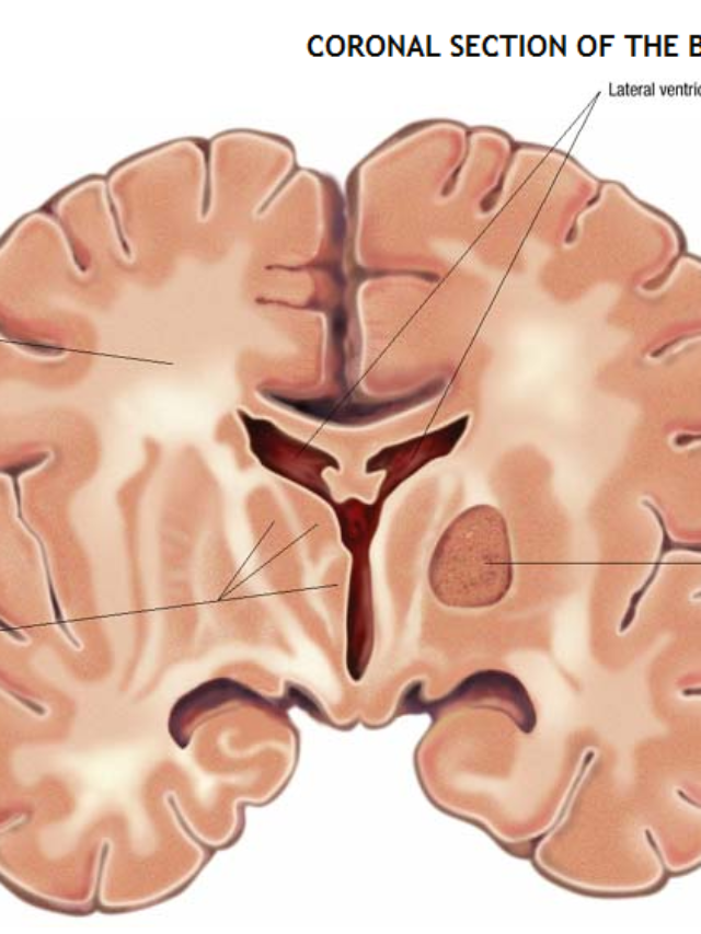 Neurological disorder